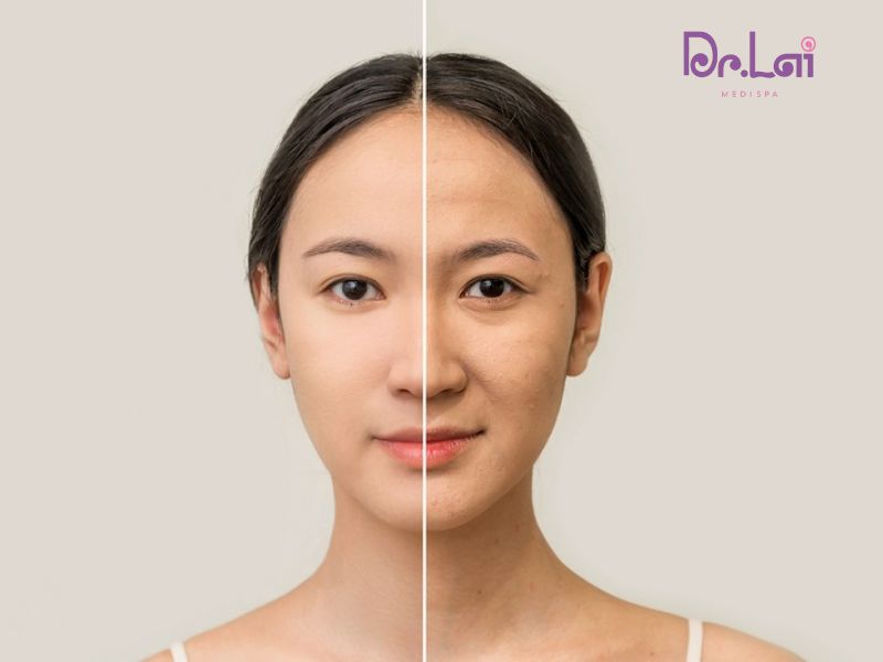 Tại sao nên thực hiện nâng cơ HIFU tại Phòng khám da liễu Dr Lai?