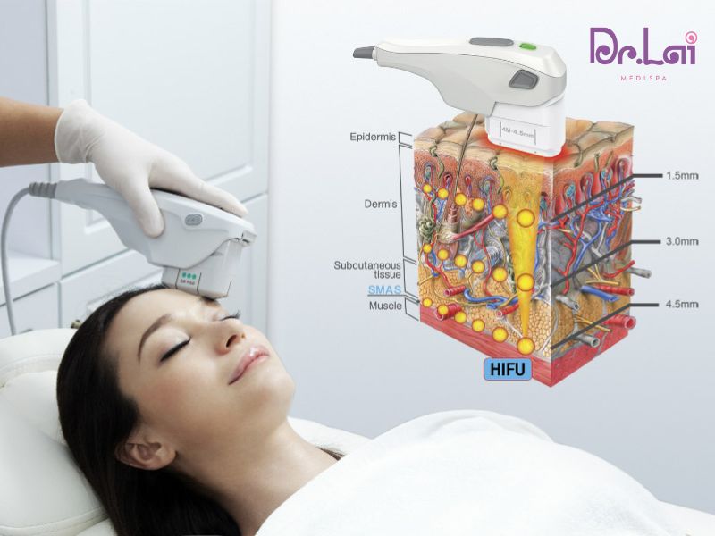 So sánh chi tiết: HIFU và Phẫu thuật thẩm mỹ