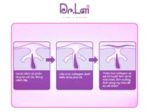 Cơ chế hình thành thâm mụn và các loại thâm thường gặp