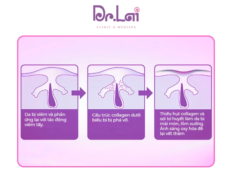 Cơ chế hình thành thâm mụn và các loại thâm thường gặp